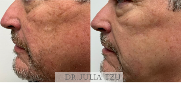 Before and after facial cyst removal by Dr. Julia Tzu at Wall Street Dermatology