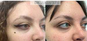 Before and After Cosmetic Mole Removal Surgery