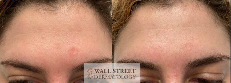 Before and after a forehead scar left by a mole removal performed elsewhere, treated with pulsed dye laser and subcision by Dr. Julia Tzu at Wall Street Dermatology, six months after one session of each